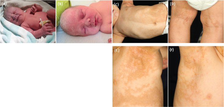 Congenital Segmental Erosions and Hyperkeratotic Plaques in a Male Infant: A Quiz.