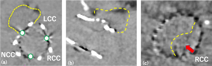 Infective endocarditis with perivalvular abscess following sutureless valve implantation, successfully treated with aortic root reconstruction and biological Bentall procedure.