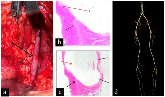 Cystic adventitial disease of the popliteal artery in female: case report and literature review of a rare differential diagnose of artery stenosis.