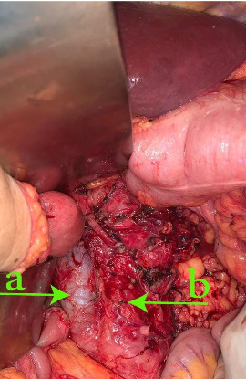 An Extremely Rare Anomaly: Unveiling Renal Vein-Originated Leiomyosarcoma.