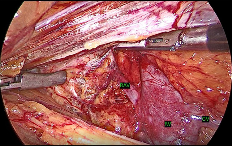 Optimized Surgical Outcomes in Living Donor Nephrectomy: A Single-Center Experience with 250 Cases Using a Novel Technique.