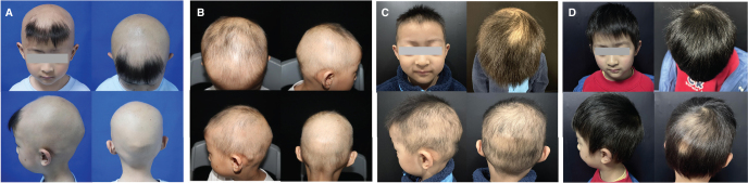 Intermittent Low-dose Ritlecitinib in Refractory Paediatric Alopecia Areata: A Case Report with Therapeutic Implications.