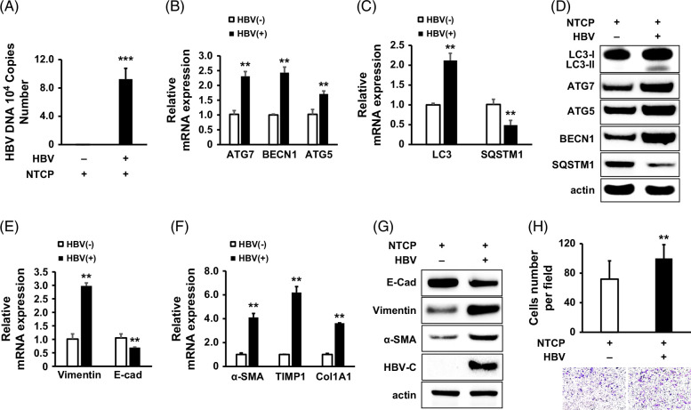 HBV promotes epithelial-mesenchymal transition in HCC and liver fibrosis through JNK-mediated autophagy.