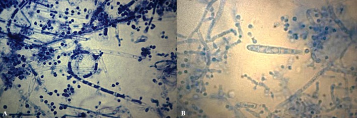 Zoonotic and Anthropophilic Trichophyton mentagrophytes Complex Infection in Human: An Update and Narrative Review.