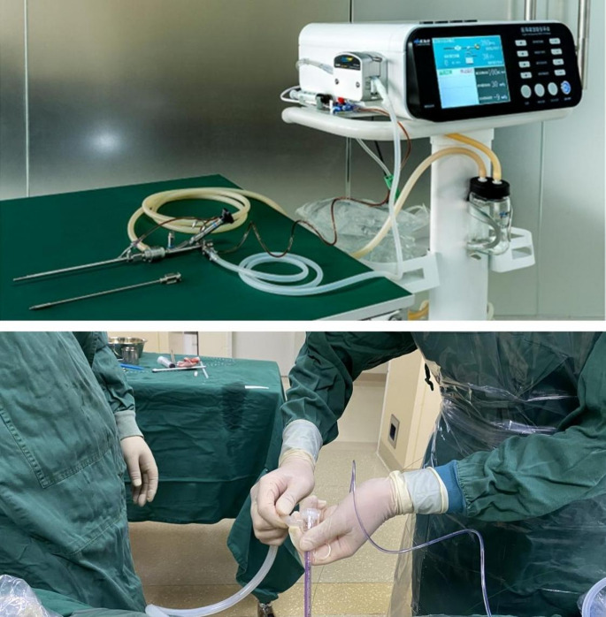 Intelligent pressure-controlled retrograde intrarenal surgery versus microchannel percutaneous nephrolithotomy to treat 2-3 cm renal calculi.