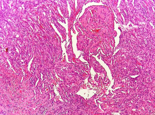 Immunohistochemical Analysis of Oral Spindle Cell Hemangioma.