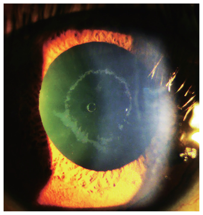 Pseudoexfoliative Deposits on an Implantable Collamer Lens: A Case Report.