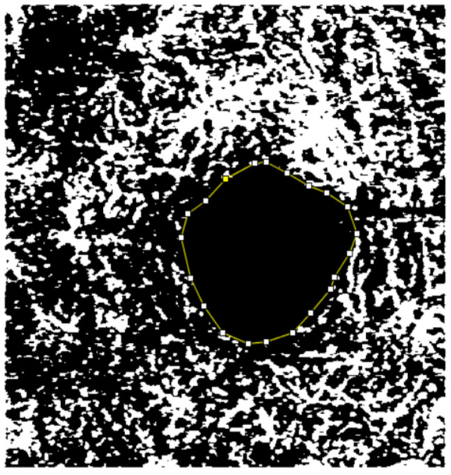 Effect of disease duration on foveal microvasculature assessed by OCTA in type 2 diabetes mellitus without clinical diabetic retinopathy.