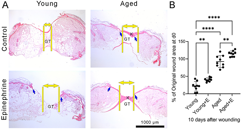 Stress-stimulated epinephrine induces premature senescence in dermal fibroblasts and contributes to impaired skin wound healing.