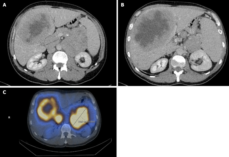 Pancreatic neuroendocrine tumors: A case-based evidence review.