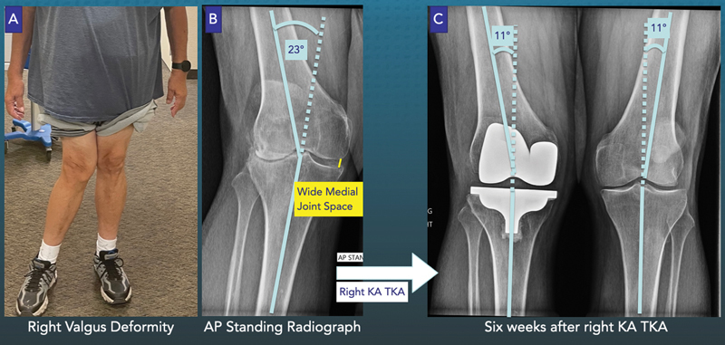 No Radiographic Evidence of Medial Collateral Ligament Elongation in Valgus Osteoarthritic Knees Enables Treatment with Kinematically Aligned Total Knee Arthroplasty.