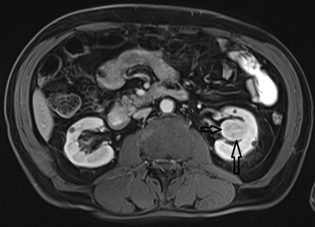 Long live the kidney despite every threats: a case report.