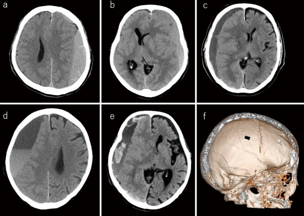 Factors Related to Recurrence and Complications after Percutaneous Subdural Tapping for Chronic Subdural Hematomas (Aoki Method): Clinical Experiences of 383 Patients with Chronic Subdural Hematomas.
