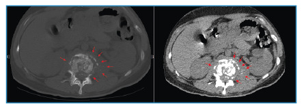 Shining star-like appearance in Pott's disease.