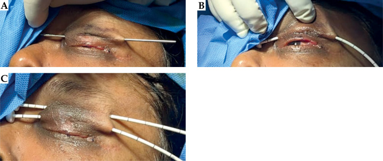 The irreplaceable art of brachytherapy: A technical note on interstitial high-dose-rate interventional radiotherapy (brachytherapy) in eyelid tumors.