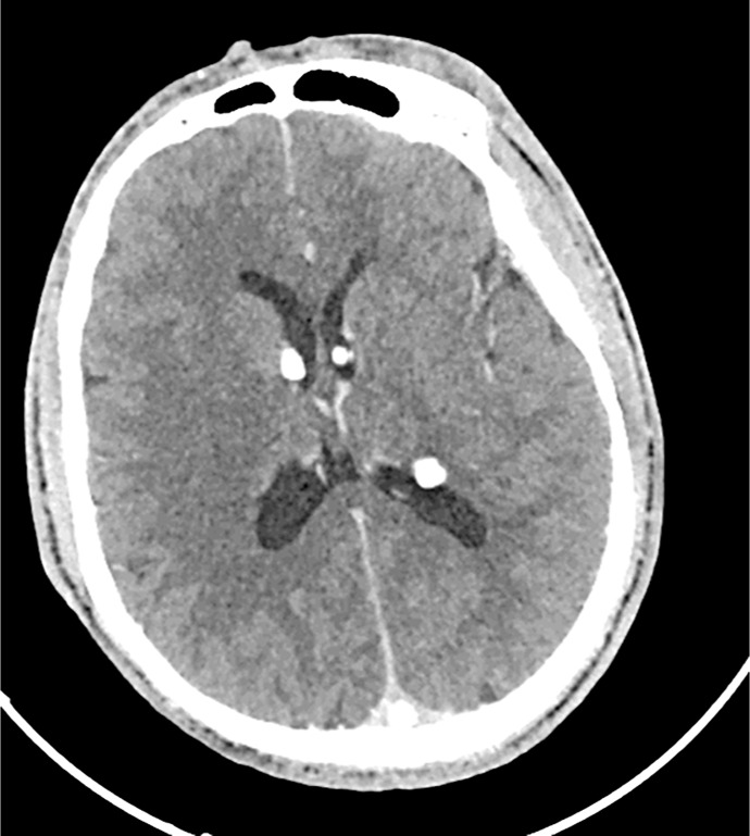 Challenges in the Diagnosis and Care of Tuberous Sclerosis Complex in Resource-Limited Settings: A Case Report from Tanzania.