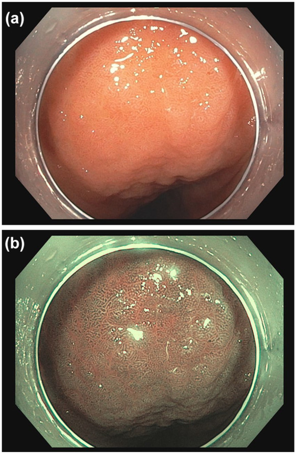 The impact of artificial intelligence on the endoscopic assessment of inflammatory bowel disease-related neoplasia.