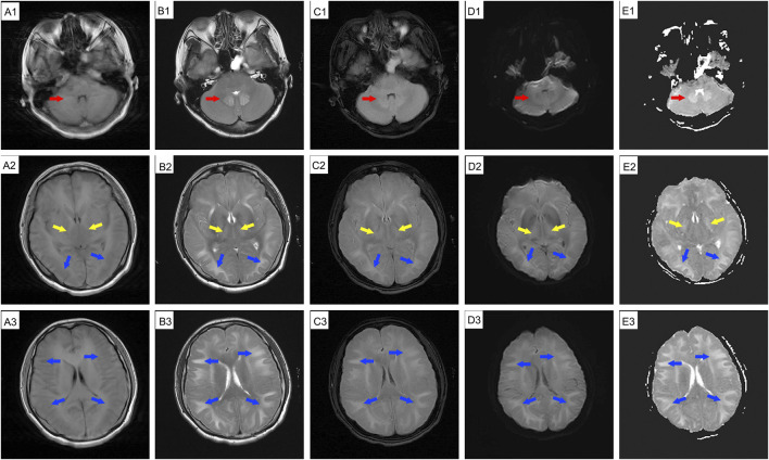 Case Report: Evaluating toxic encephalopathy from occupational 1,2-dichloroethane exposure: magnetic resonance imaging contributions.