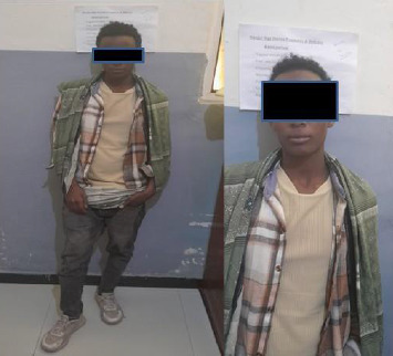 Suspected Ovotesticular Disorders of Sexual Differentiation in a Phenotypic Male With Ambiguous Genitalia, Light Menstrual Flow, and Synchronous Bilateral Dysgerminoma: A Case Report From Ethiopia.