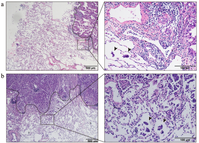 CT feature-based nomogram for predicting tumor spread through air spaces in stage IA lung adenocarcinoma.