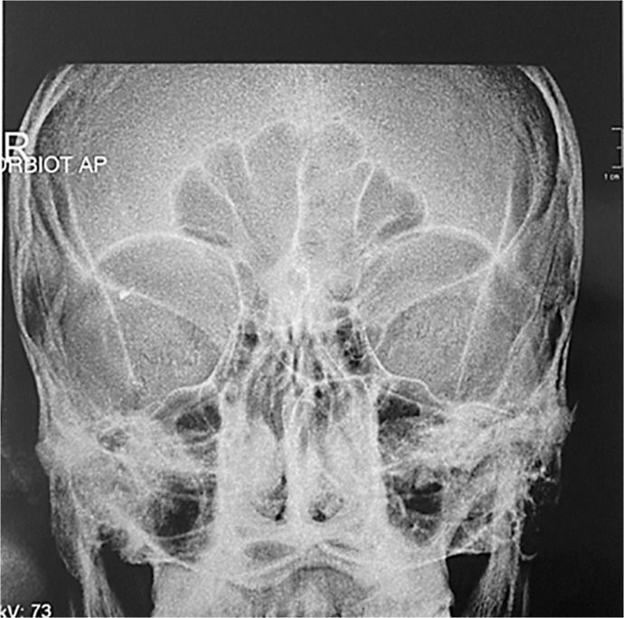 Magnetic Extraction of an Intraretinal Foreign Body: A Case Report.