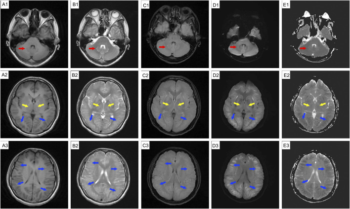 Case Report: Evaluating toxic encephalopathy from occupational 1,2-dichloroethane exposure: magnetic resonance imaging contributions.