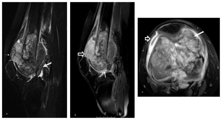 Diagnosis of knee joint invasion in patients with osteosarcoma: the value of direct and indirect MRI findings.