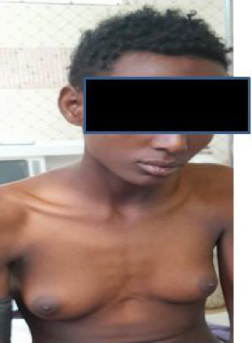 Suspected Ovotesticular Disorders of Sexual Differentiation in a Phenotypic Male With Ambiguous Genitalia, Light Menstrual Flow, and Synchronous Bilateral Dysgerminoma: A Case Report From Ethiopia.