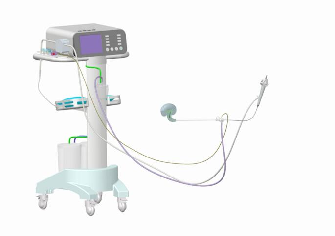 Intelligent pressure-controlled retrograde intrarenal surgery versus microchannel percutaneous nephrolithotomy to treat 2-3 cm renal calculi.