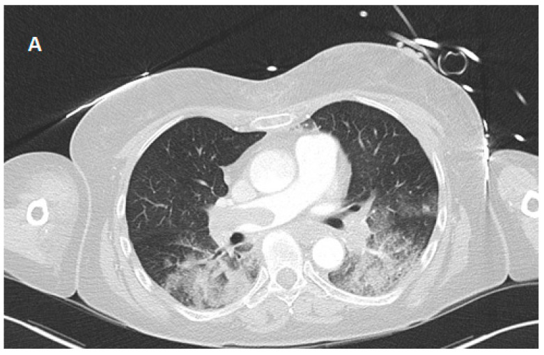 Case Report of Successful Extracorporeal CPR (eCPR) in Refractory Cardiac Arrest Caused by Fulminant Pulmonary Embolism with Remarkable Recovery.