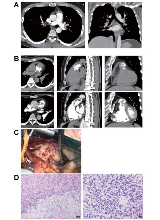 Acute Pulmonary Embolism: The Clinical Value of Early Follow-Up Computed Tomography Imaging in Thrombus Regression and Rare Differential Diagnoses of Pulmonary Intimal Sarcoma.