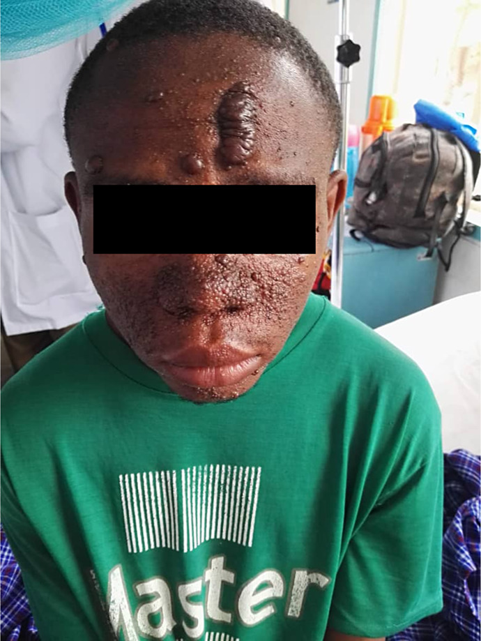 Challenges in the Diagnosis and Care of Tuberous Sclerosis Complex in Resource-Limited Settings: A Case Report from Tanzania.