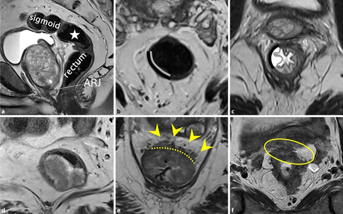 [Role of radiology for primary staging of colorectal cancer].