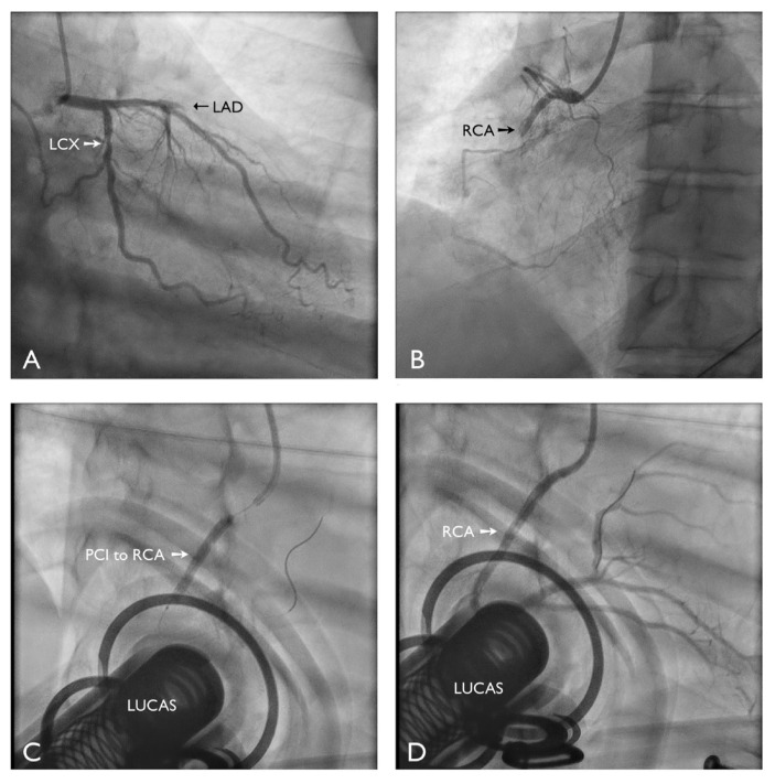 Successful Primary Coronary Intervention During Prolonged Mechanical Cardiopulmonary Resuscitation for Acute Myocardial Infarction-related Cardiac Arrest.