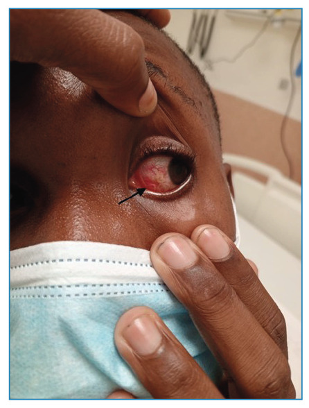 Ocular Filariasis caused by Loa loa infection.