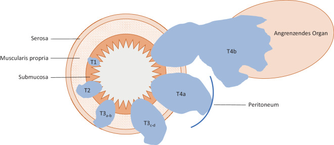 [Role of radiology for primary staging of colorectal cancer].