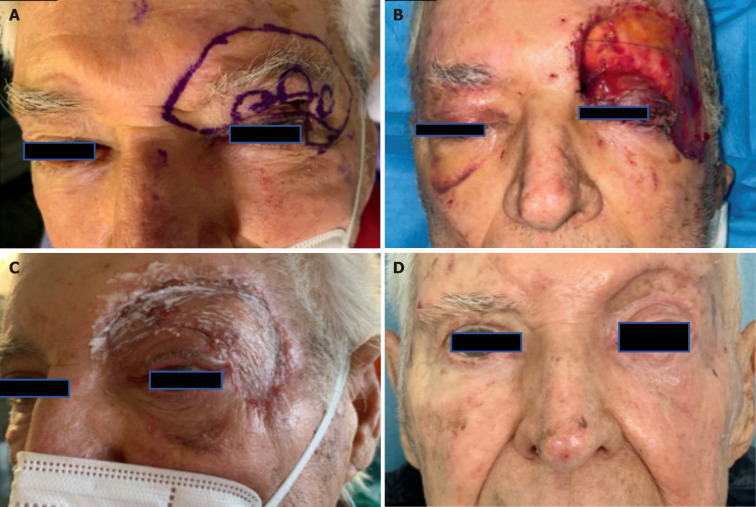 Development and validation of a decision algorithm for eyelid reconstruction following oncological resection.