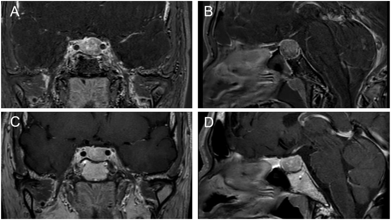 Effects of lanreotide autogel immediately after a single injection for thyrotropin-producing pituitary tumor.