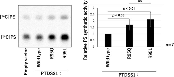 A Japanese Case of Lenz-Majewski Syndrome With a Novel PTDSS1 Variant.