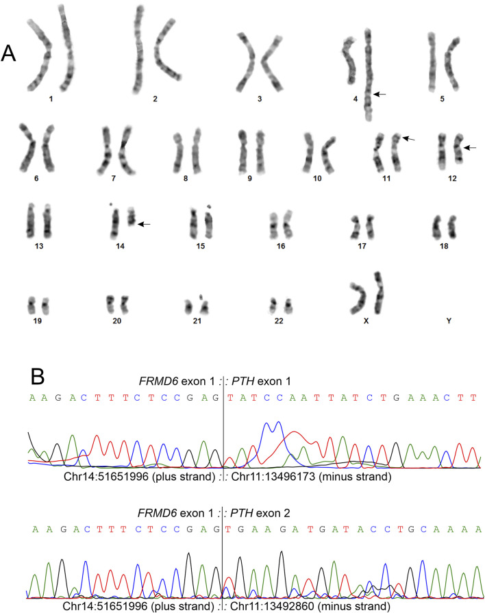 Novel <i>FRMD6::PTH</i> chimera in tumorous bone lesion carrying a t(4;11;14;12)(q35;p15;q22;q13).