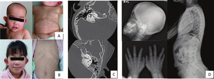 A Japanese Case of Lenz-Majewski Syndrome With a Novel PTDSS1 Variant.