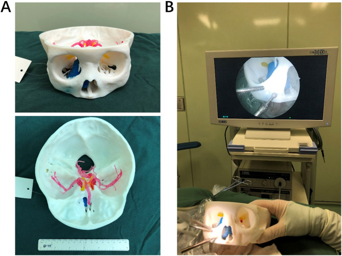 Enhancing skull base tumor management: the combination of 3D printing technology and endoscopic surgical techniques.