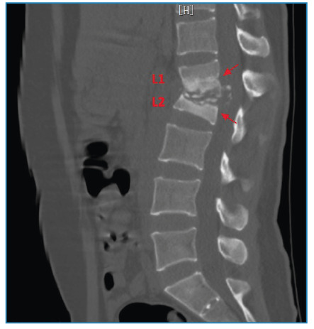 Shining star-like appearance in Pott's disease.