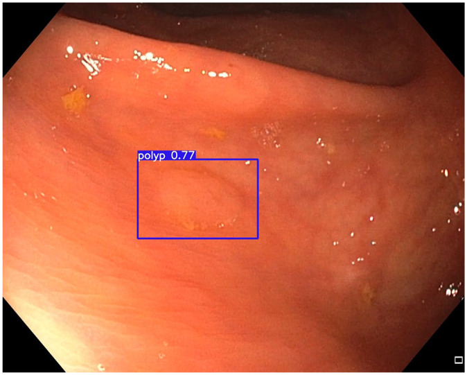 The impact of artificial intelligence on the endoscopic assessment of inflammatory bowel disease-related neoplasia.