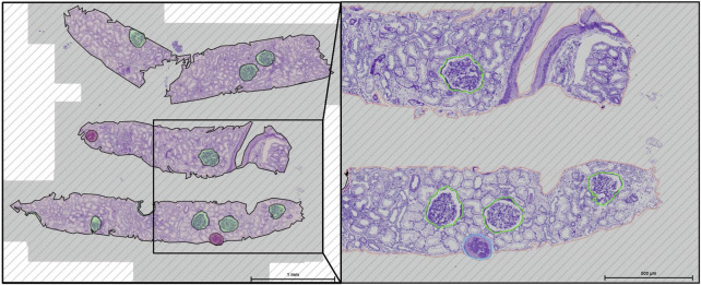 Clinical and Histopathological Determinants for Kidney Allograft Survival in the Eurotransplant Senior Program (ESP) at the Time of Allocation.