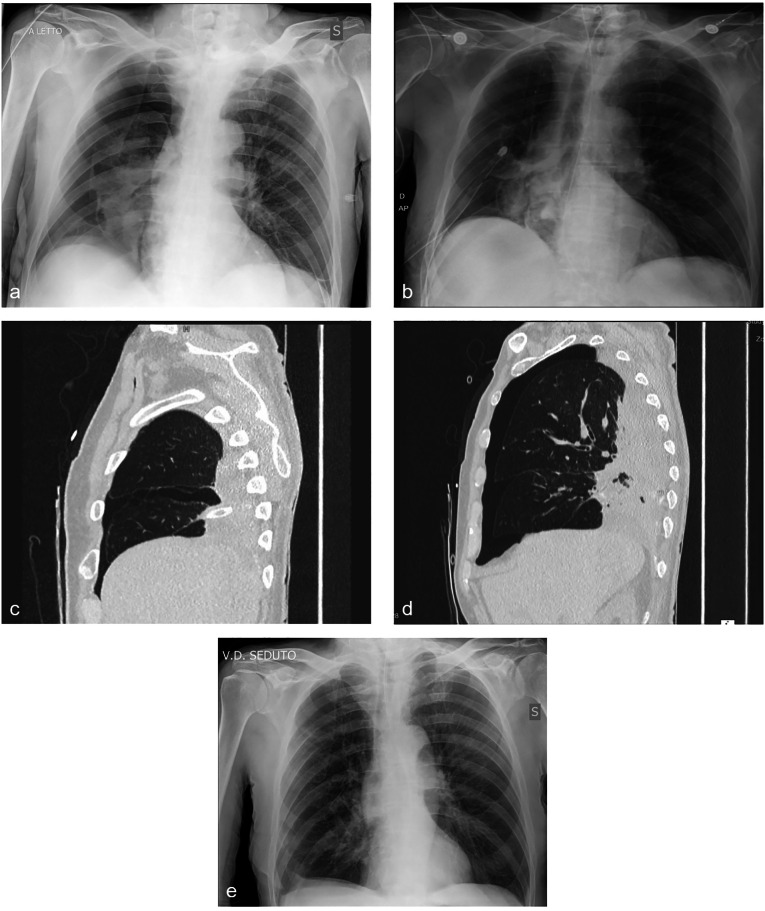 A Practical Approach to Pneumothorax Management.