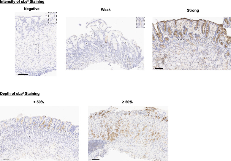 Patterns of sialyl-Lewis X expression predict gastric histopathology.