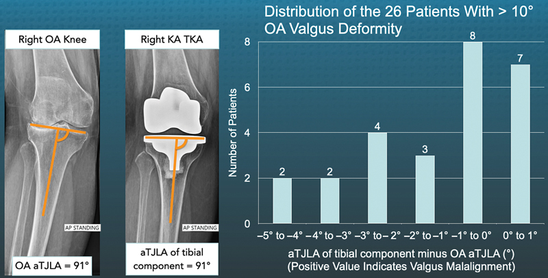 No Radiographic Evidence of Medial Collateral Ligament Elongation in Valgus Osteoarthritic Knees Enables Treatment with Kinematically Aligned Total Knee Arthroplasty.