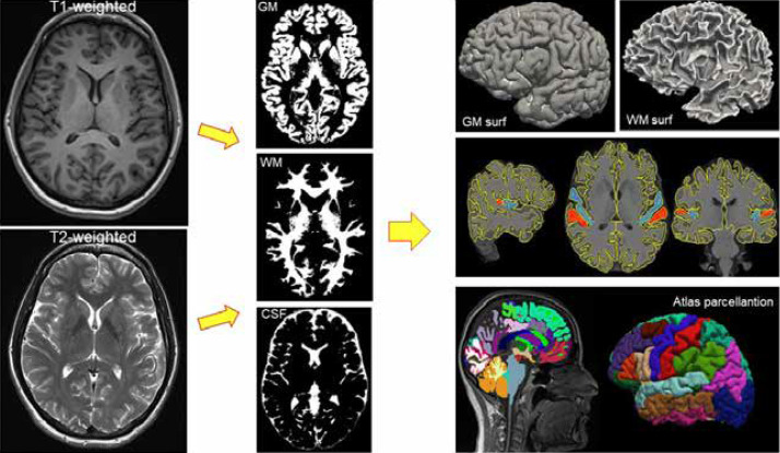 Quantitative brain volumetry in neurological disorders: from disease mechanisms to software solutions.
