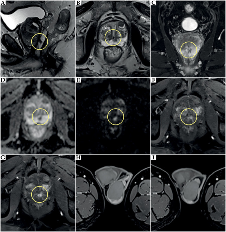 Orchiepididymitis as a rare complication of TURP performed four weeks after high-dose-rate brachytherapy for prostate cancer.